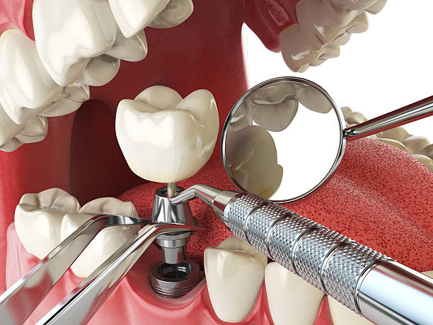 Best Emergency Dentist for Lost Fillings or Crowns in Harvey, IL